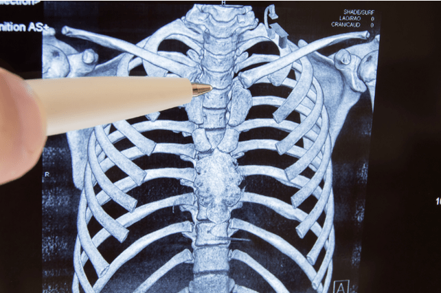 osteochondroza