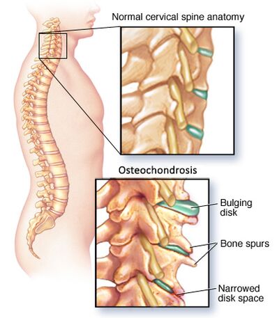Osteochondroza szyjka macicy