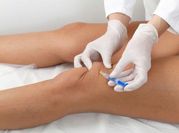 zastrzyk dostawowy w przypadku artrozy stawu kolanowego