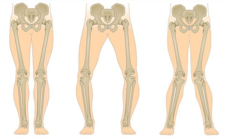 powikłania artrozy stawu kolanowego